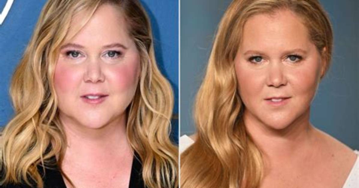 Amy Schumer Moon Face Transformation the Truth Behind Her Dramatic Before And