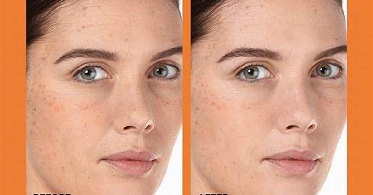Before and After at the C Spot La Dermatologist Insights And