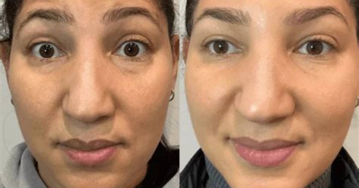 Before and After Total Relief