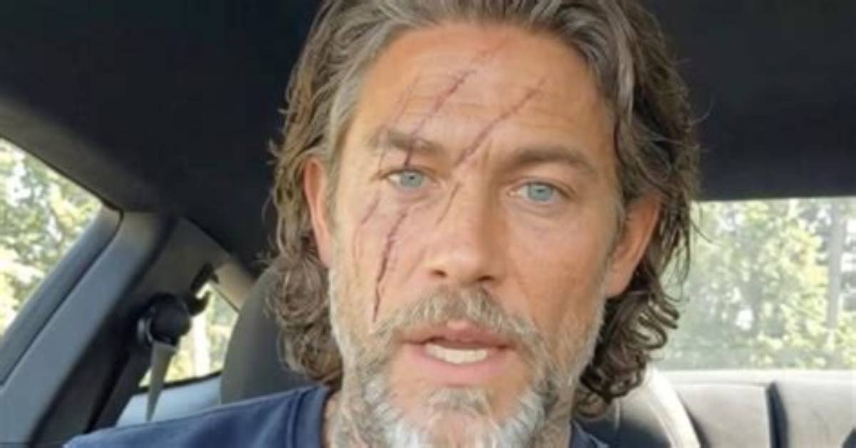 Beyer Hunter Face Scars Revealed Before and After Clips Fuel