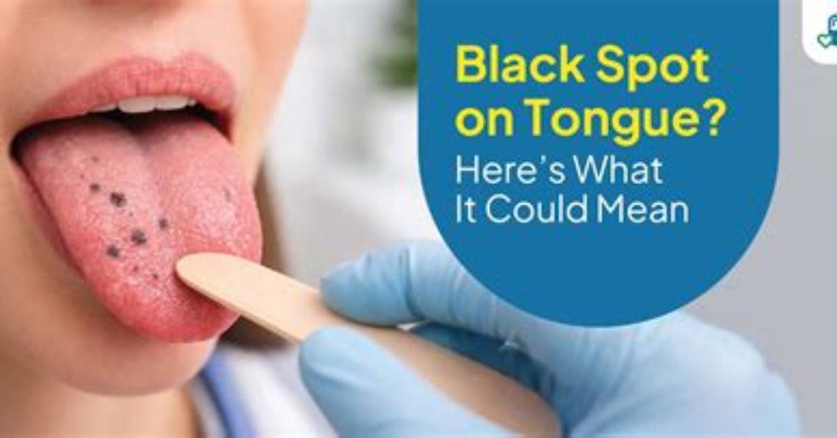Black Dots on the Tongue When Sudden Oral Spots Signal an Urgent