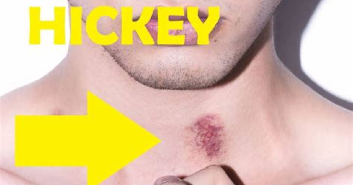 Can a Hickey Actually Cause Serious Medical Harm Separating Myths From