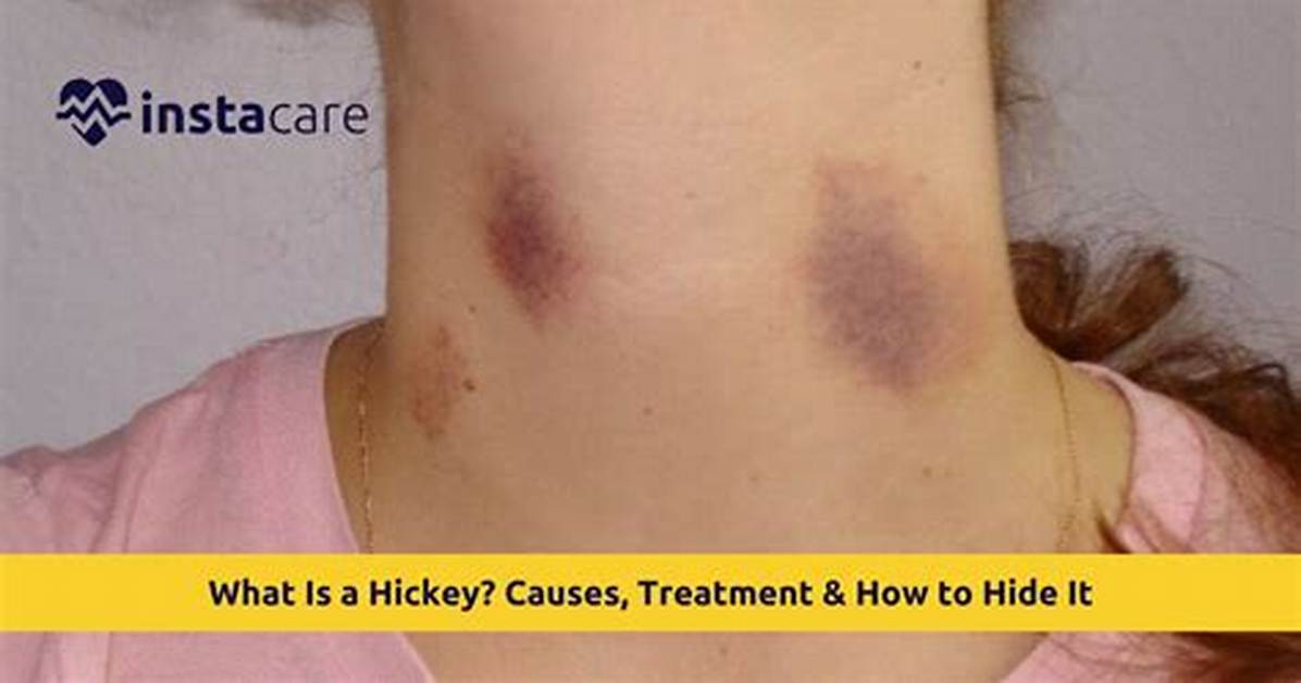Can a Hickey Actually Cause