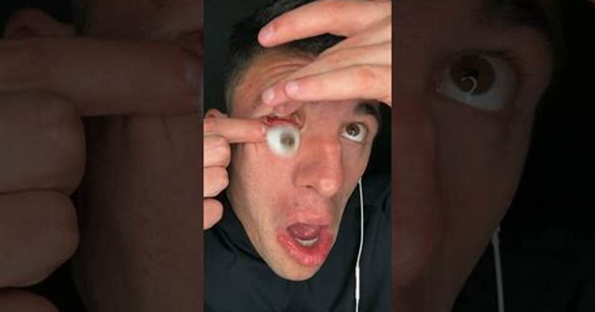 Can an Eyeball Truly Pop out from Blunt Force Medical Realities Behind The