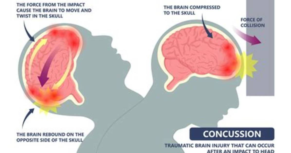 Can Cbd Heal Concussions Inside the University of Regina S Groundbreaking New