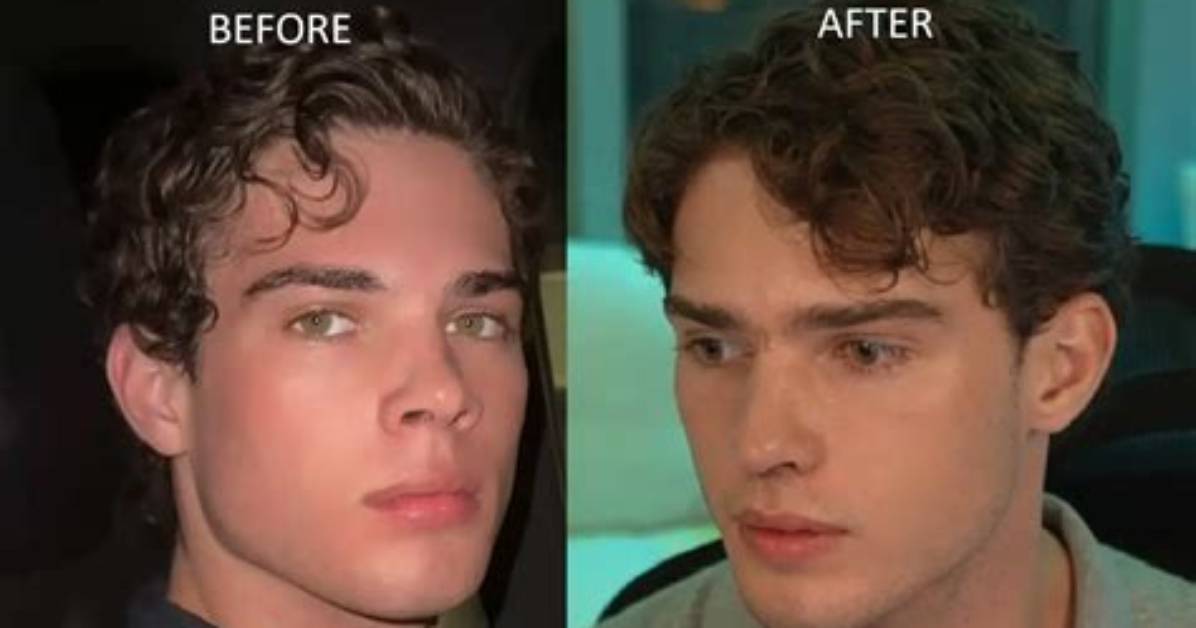 Clavicular Nose Job Before and After Photos Comparing the Streamer S
