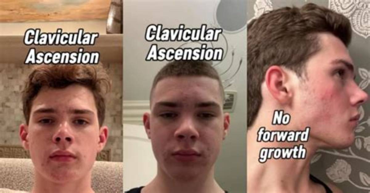 Clavicular Plastic Surgery Before and After Is His New Nose Really Too