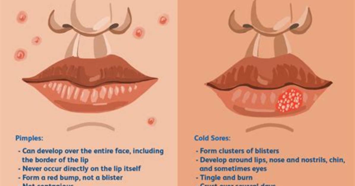 Cold Sore or Acne Bump Visual Signs and Why Pimple