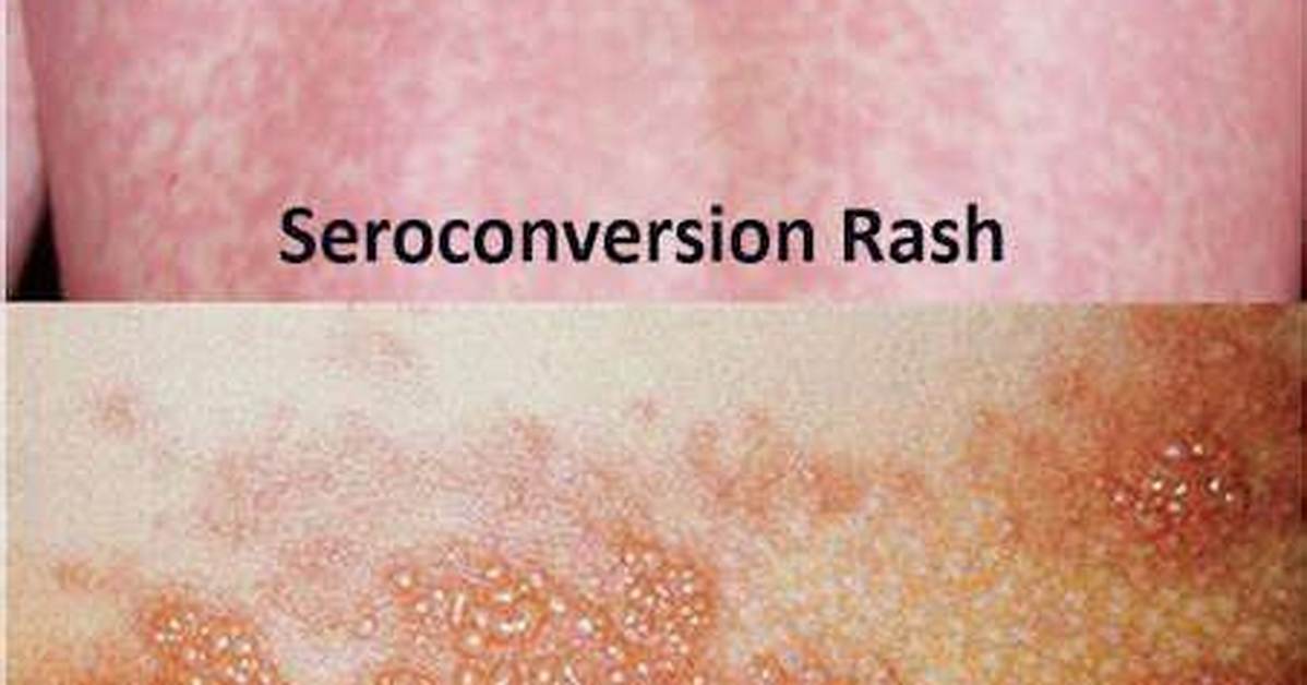 Complete Clinical Guide to Hiv Skin Rashes Identification Testing And
