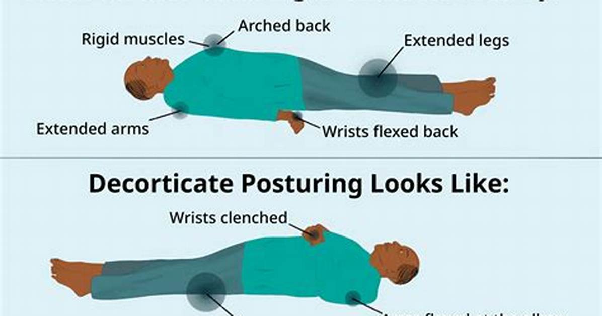 Decorticate vs Decerebrate Posture the Terrifying Neurological Signs of Severe