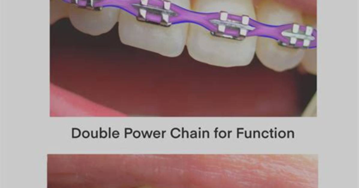 Does a Power Chain Hurt More Than Regular Braces Fact Checking The