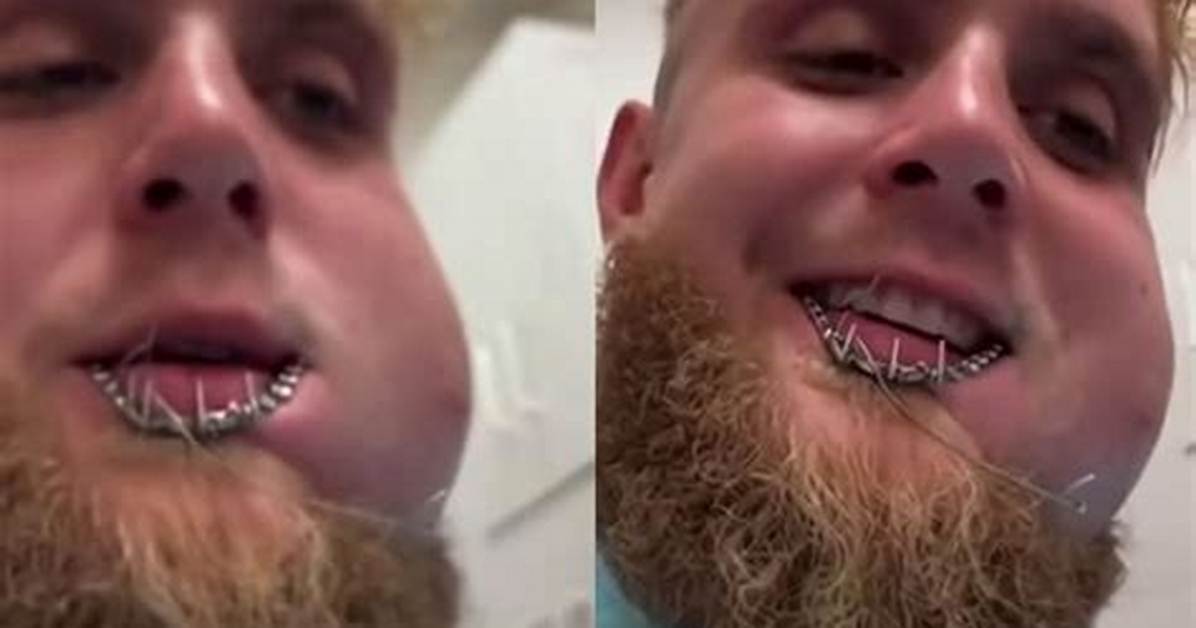 Does Jake Paul Have a Metal Jaw? Inside the Bionic Rebuilt Jaw Rumors After Joshua Ko