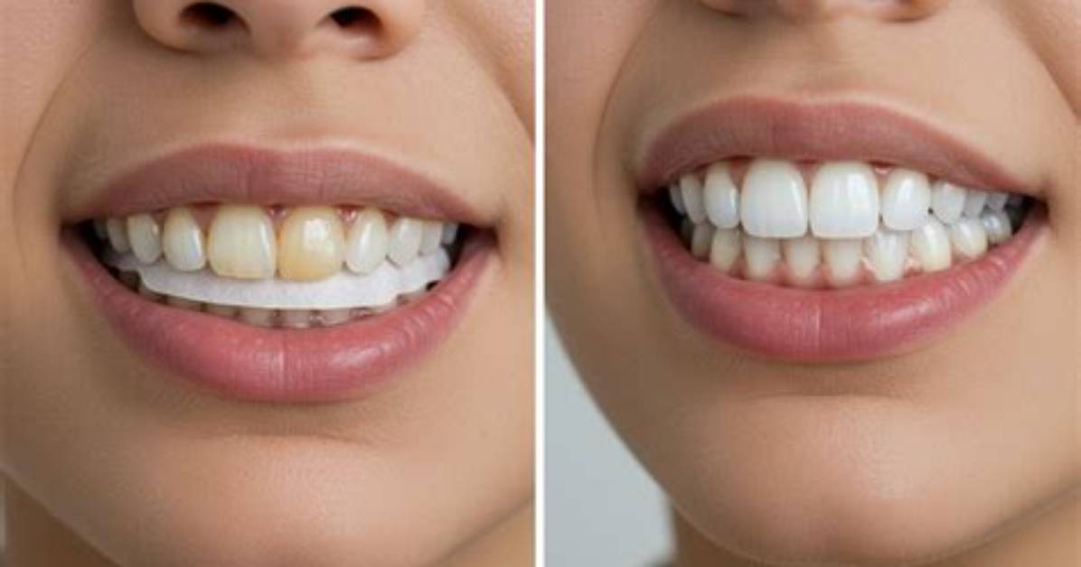 Does Smile Gloss Actually Whiten Teeth Before and After Tests And