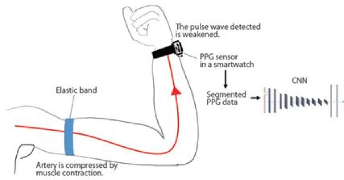 Emg Breakdown Does the Straight Arm
