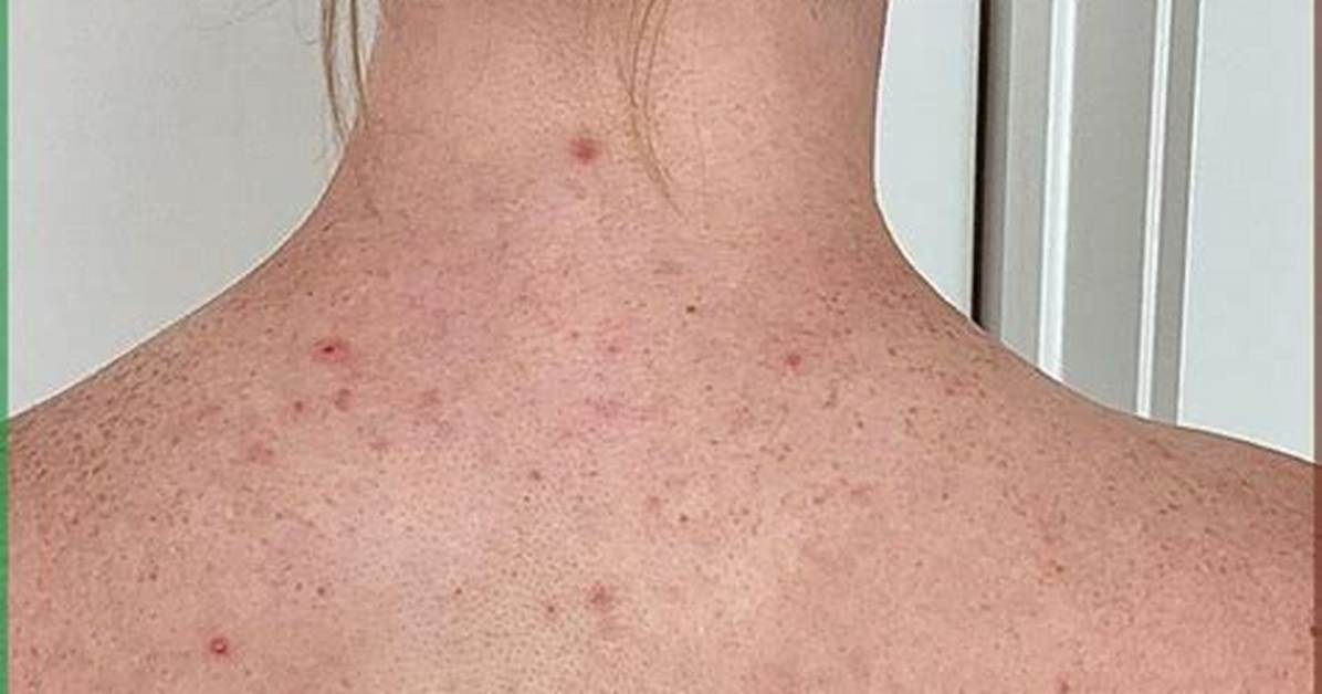 Fact Checking Ternscheese S Back Acne Trend Origin And