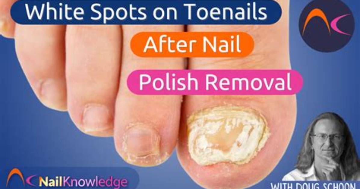Fact Checking White Toenails Dermatologists Debunk Common Myths And
