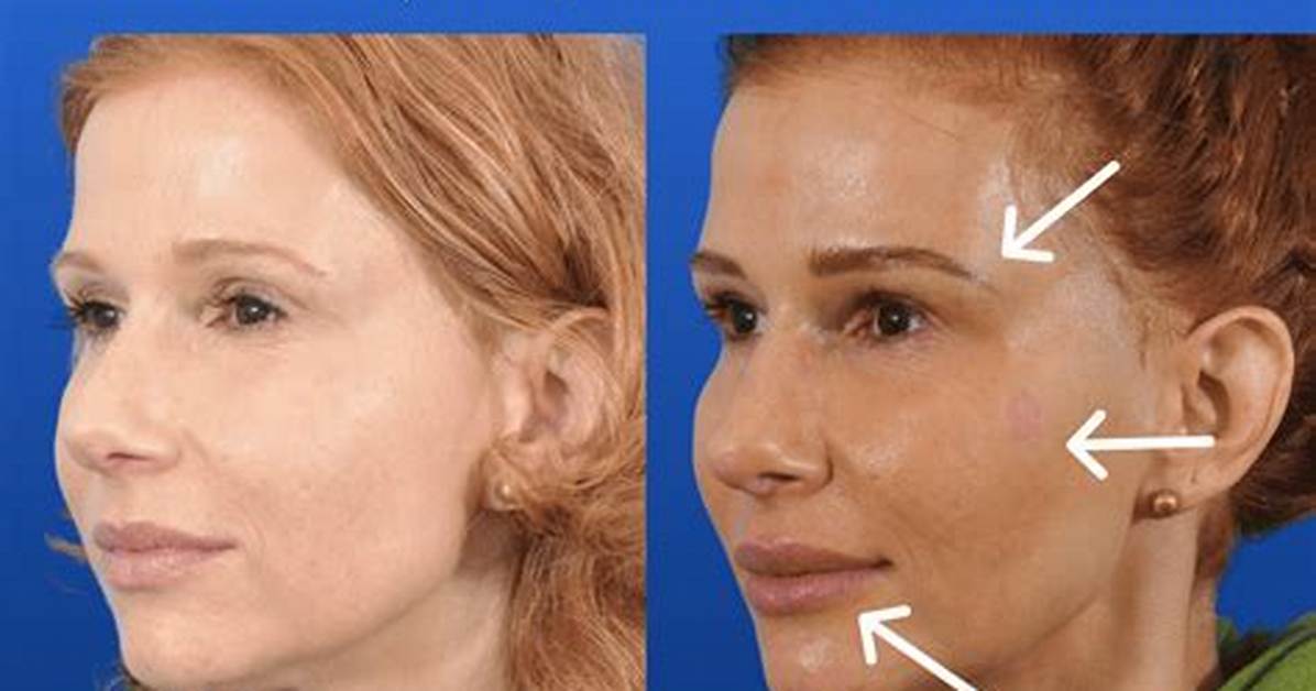 Forehead Fat Transfer vs Fillers Recovery Costs Longevity And