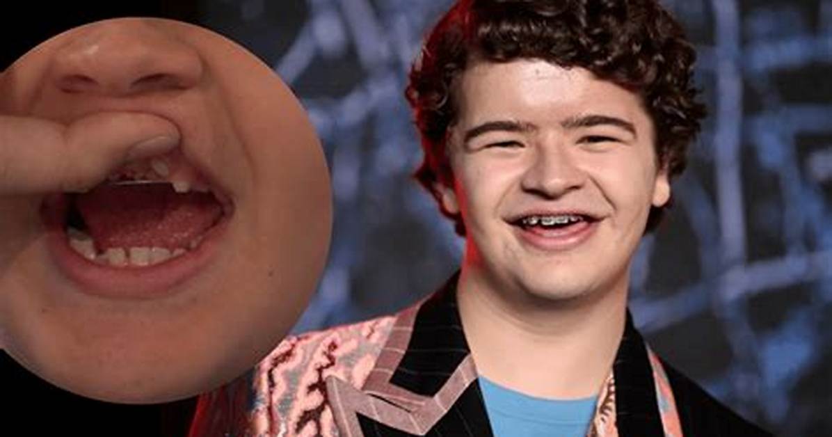 Gaten Matarazzo Teeth Transformation Before During and After Major