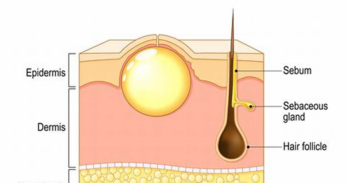 I Popped a Sebaceous Cyst the Dangerous Mistake That Leads To