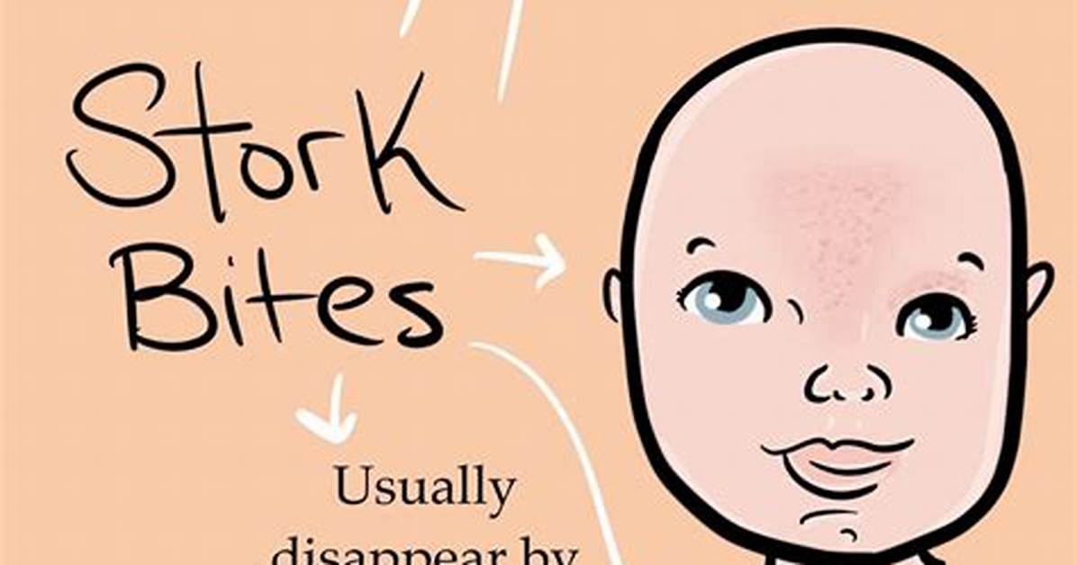 Is a Stork Bite a Sign of Mthfr Mutation the Viral Myth Debunked By