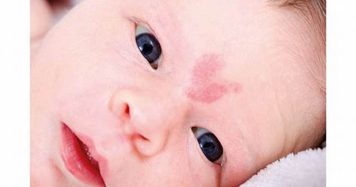 Is a Stork Bite Really a Warning Sign of Mthfr Mutation Viral