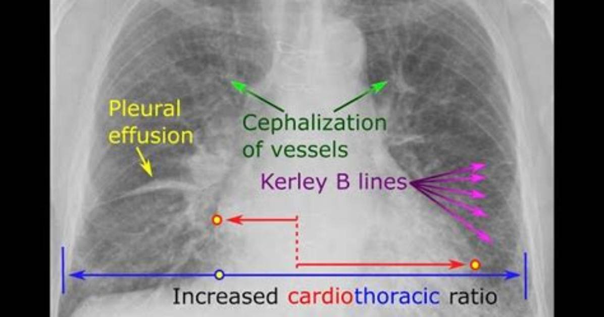 Kerley B Lines Explained Comprehensive Clinical Guide to Causes Imaging And