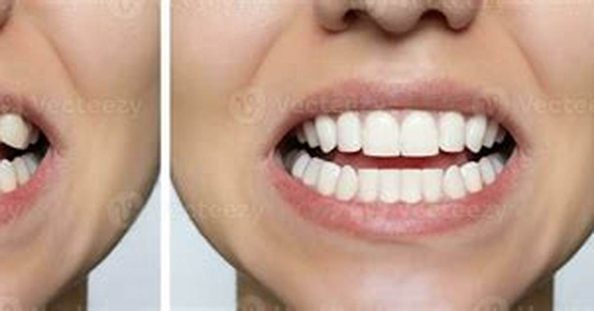 Lower Teeth Smile Before and After Visual Proof of Bite And