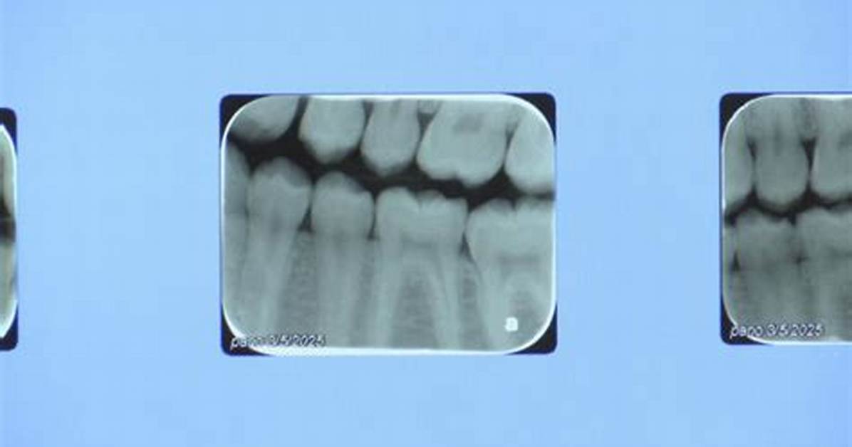 Madison Marks 12 Months Without Water Fluoride as Dental