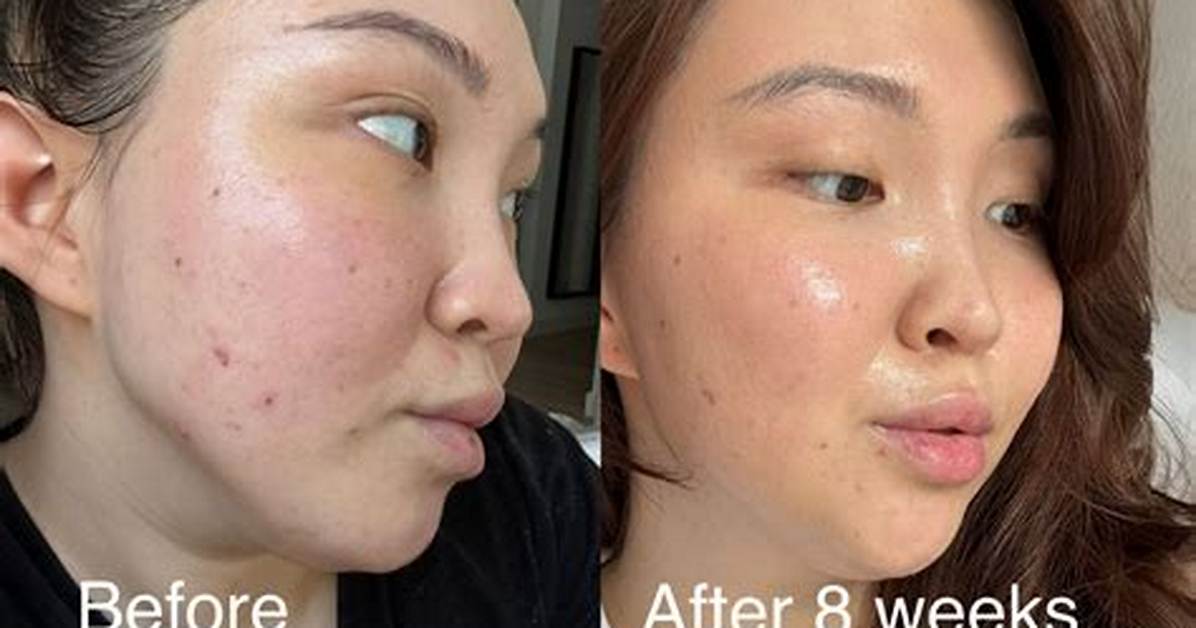 Medicube Booster Pro Real Before and After 30 Day Photo Evidence