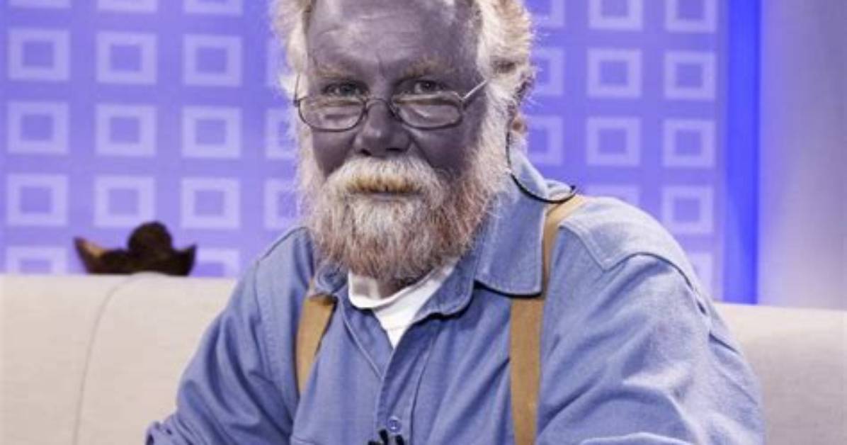 Real Humans Who Turned Blue the Shocking True Medical Cases Behind The