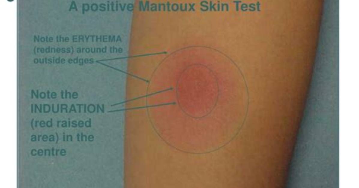 Redness vs Induration the Critical Tb