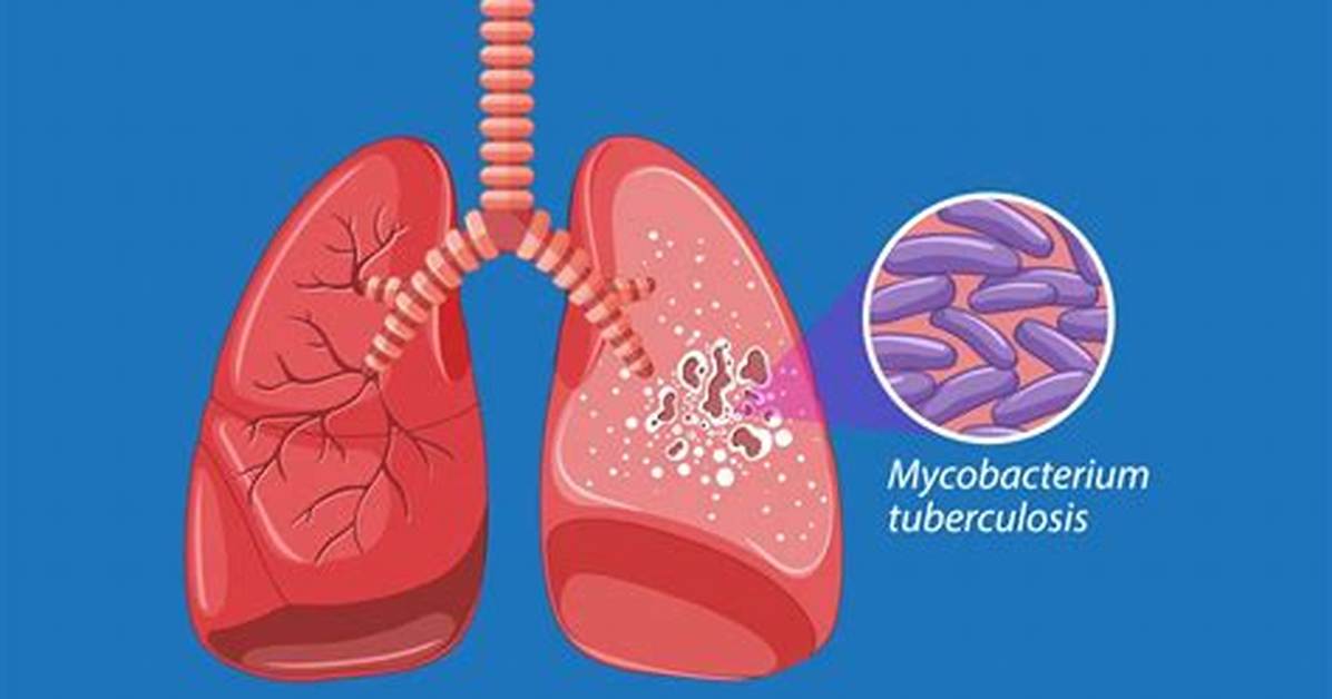 Slang or Diagnosis the Truth Behind Tb in Text Messages And