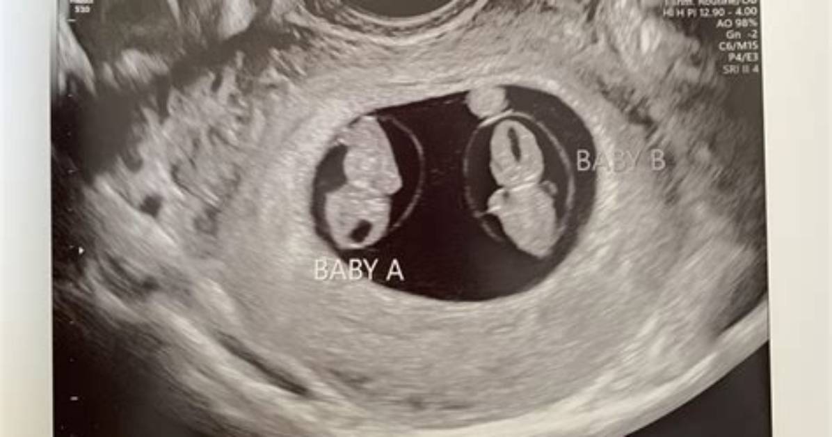 Surprise Twins at 7 Weeks What Doctors Actually Look for on Your