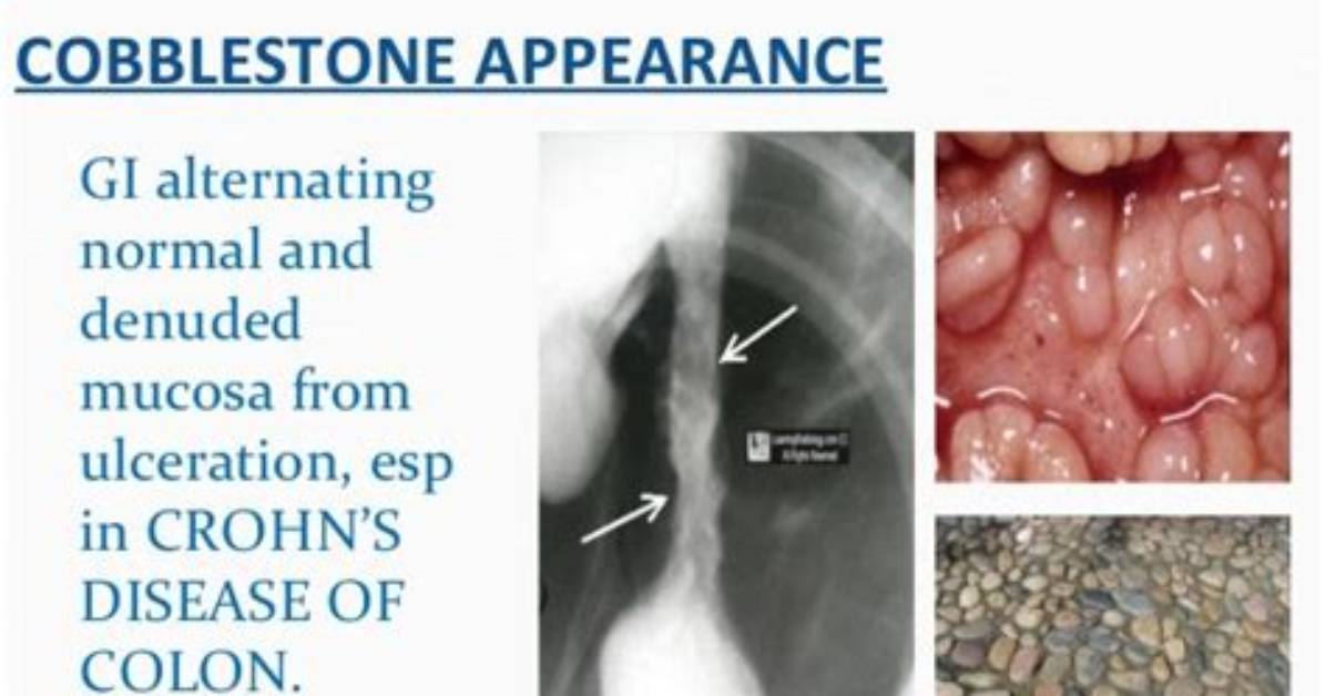 The Patient S Guide to Intestinal Cobblestoning Symptoms Biopsies And