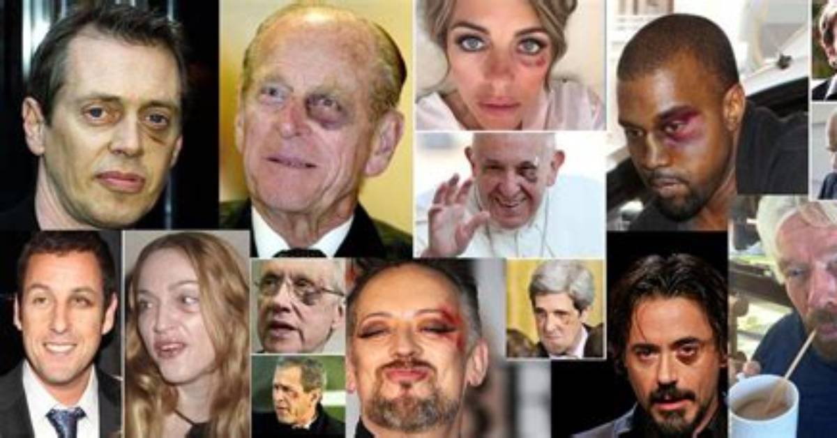 The Real Cause Behind Celebrity Panda Eyes Harsh Lighting Silica Or
