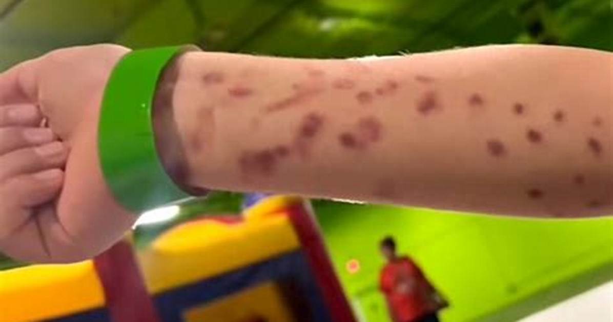 The Science of Suction Bruises Debunking Viral Hickey