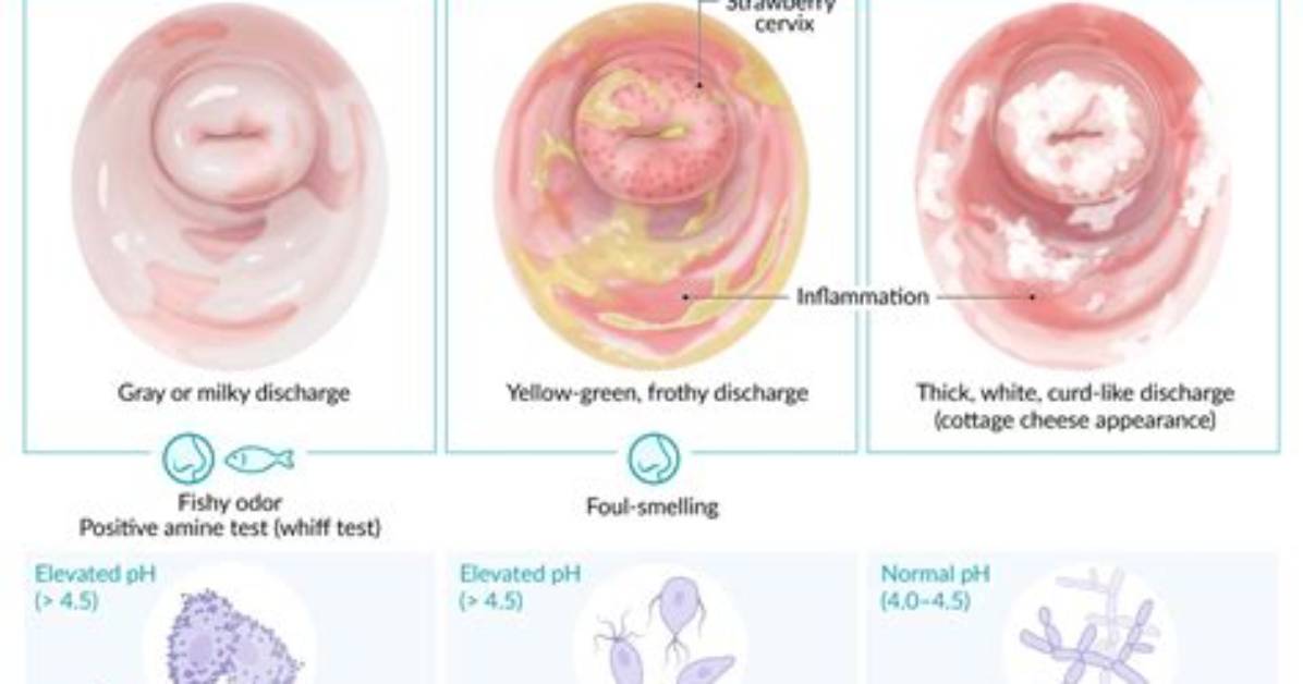 The Science of Vaginal Air What Does Queef Mean and How Does It
