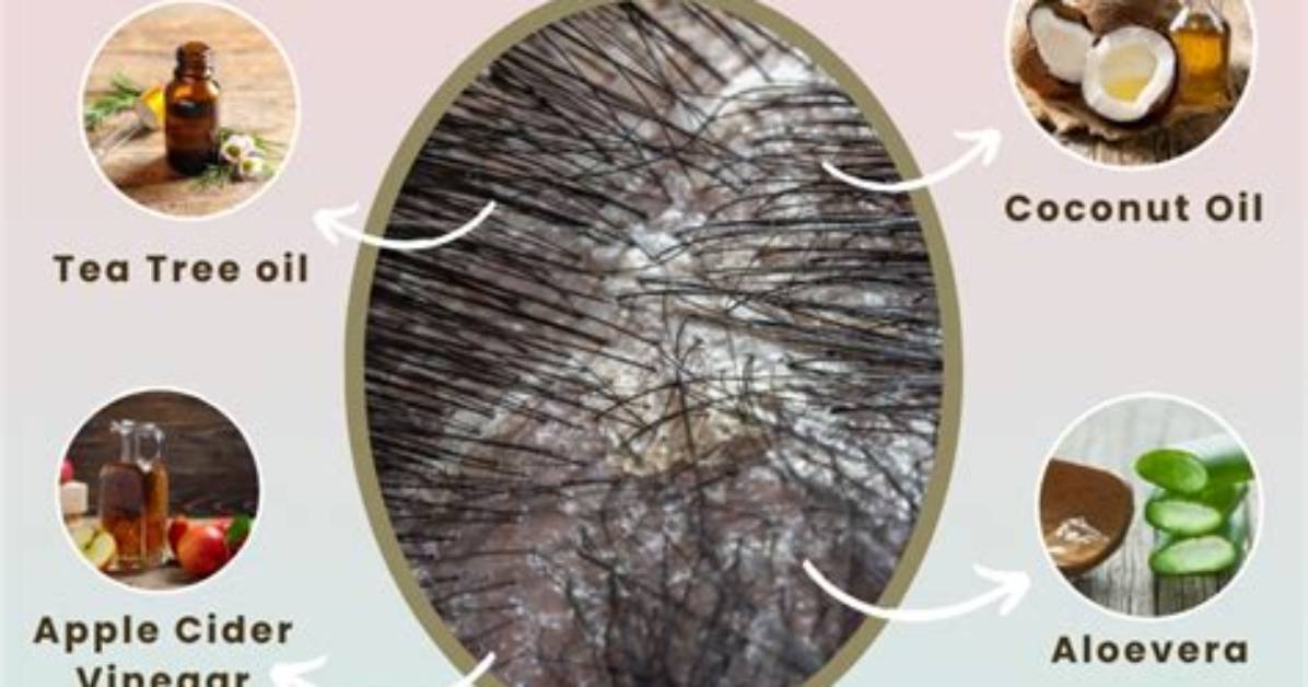 The Ultimate Guide to Scalp Fungus Busters Proven Treatments Actives And
