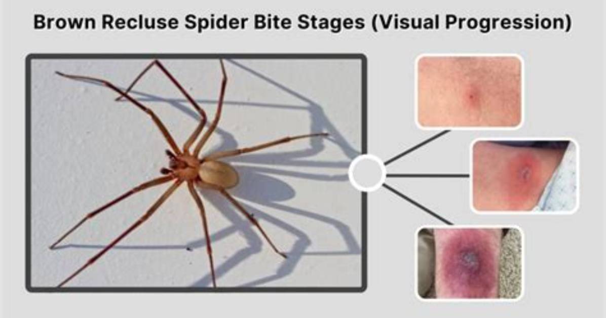 Visual Progression Guide Identifying Brown Recluse Spider Bite Stages Through