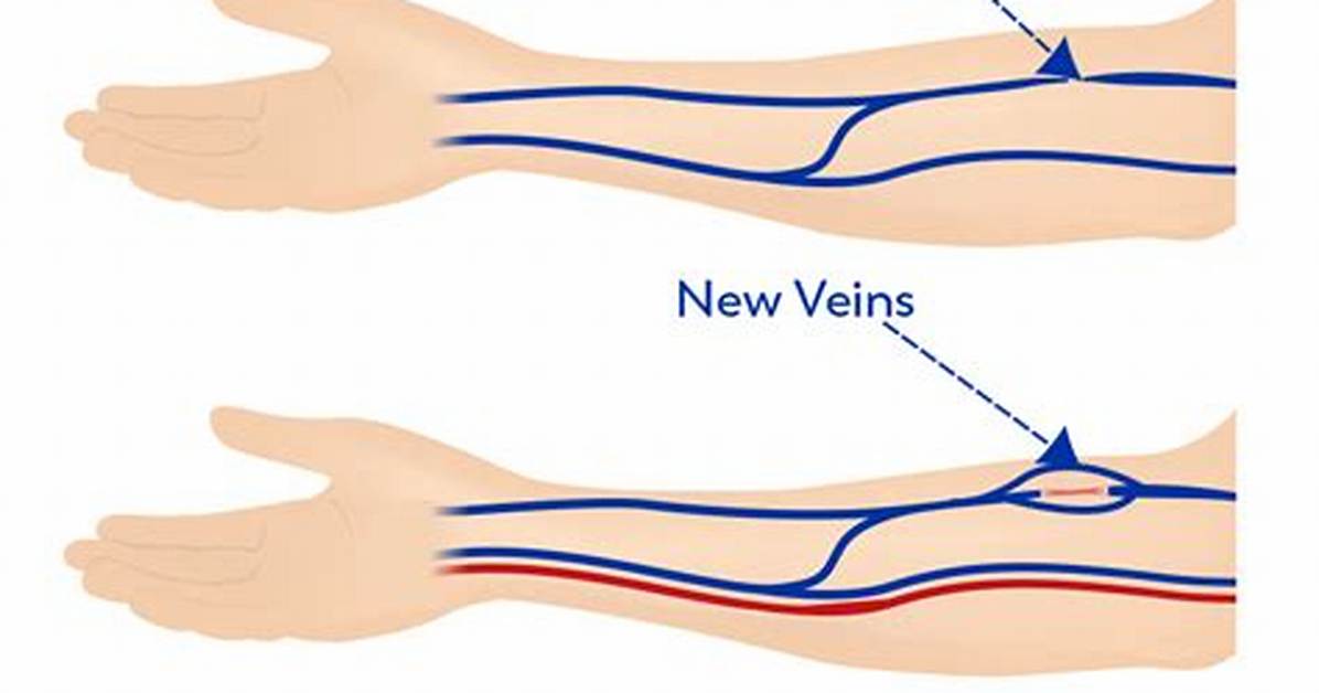 What a Blown Vein in the Wrist Actually Looks Like Visual Symptoms Hematomas And