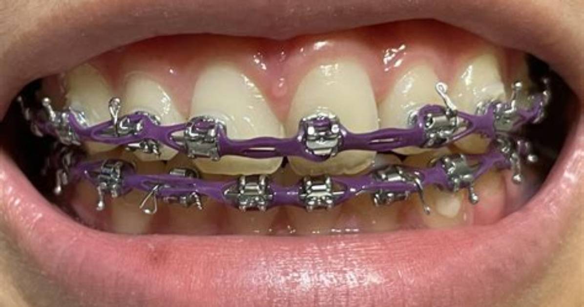 What Are Power Chain Braces the Truth About the Dreaded Gap