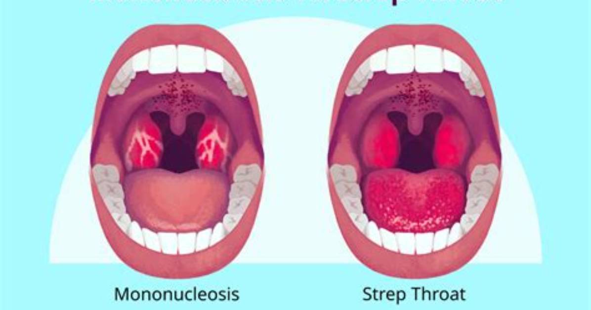 What Does a Mono Throat Look Like Faqs Home Care and Red