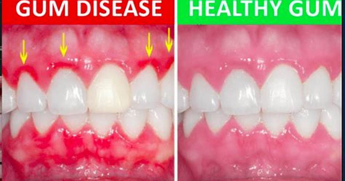 What Does Water Do for Your Gums a Complete Step by Step