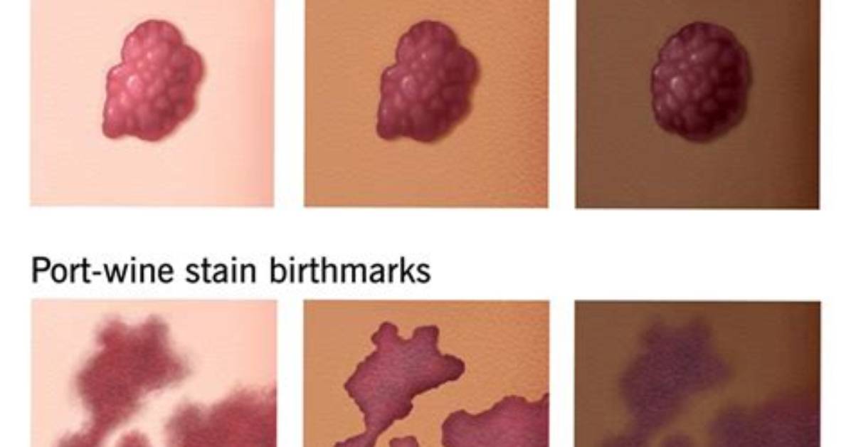 What Does Your Baby S Birthmark Indicate the Complete Parental