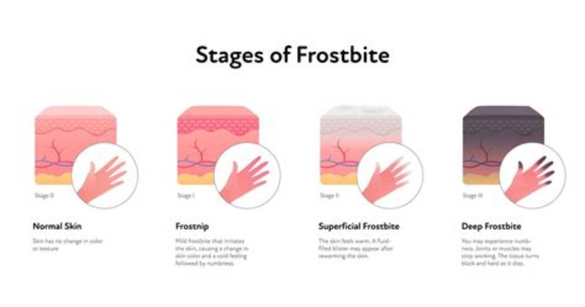 What Lip Frostbite Actually Looks Like Visual Stages from Frostnip To
