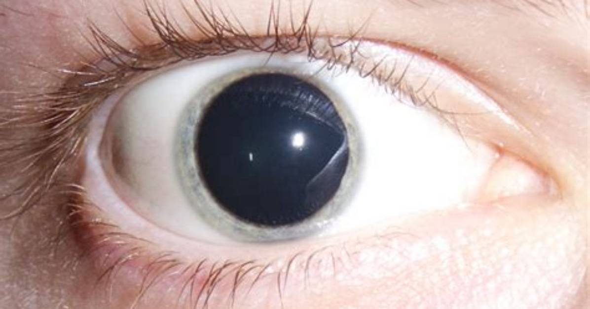 What Makes Pupils Big Separating Everyday