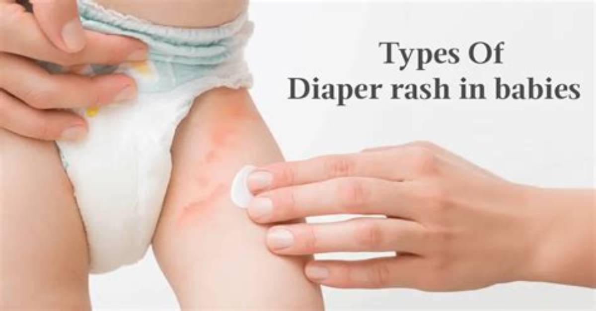 Why Kiwi Triggers Sudden Baby Diaper Rash the Solid Starts Acidic