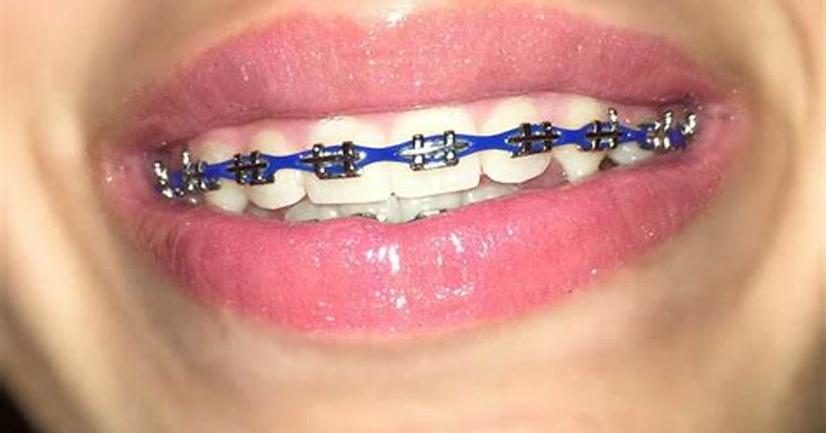 Why Royal Blue Braces Are Taking over Orthodontics the Secret Behind the Instant White