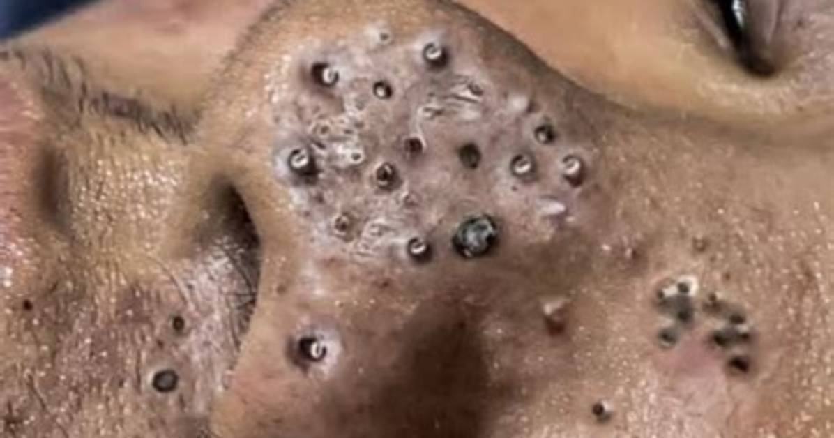 Why the Newest 2025 Nguyen Blackhead Removal Videos Are Going