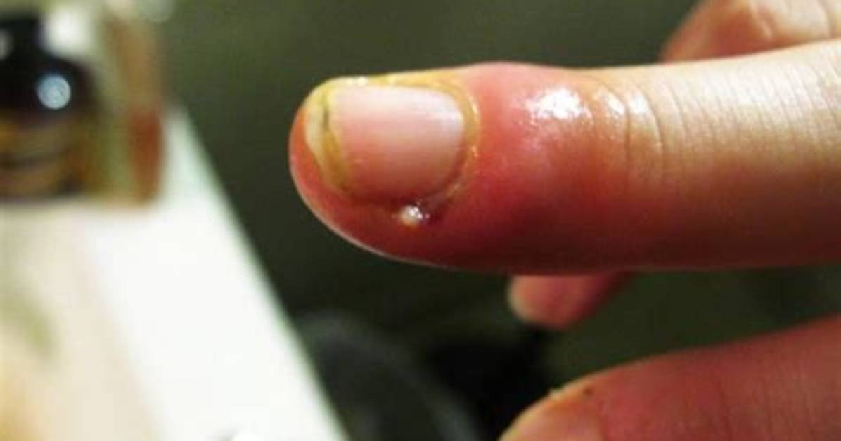 Why You Should Never Rip a Hangnail the Hidden Danger of Sepsis And
